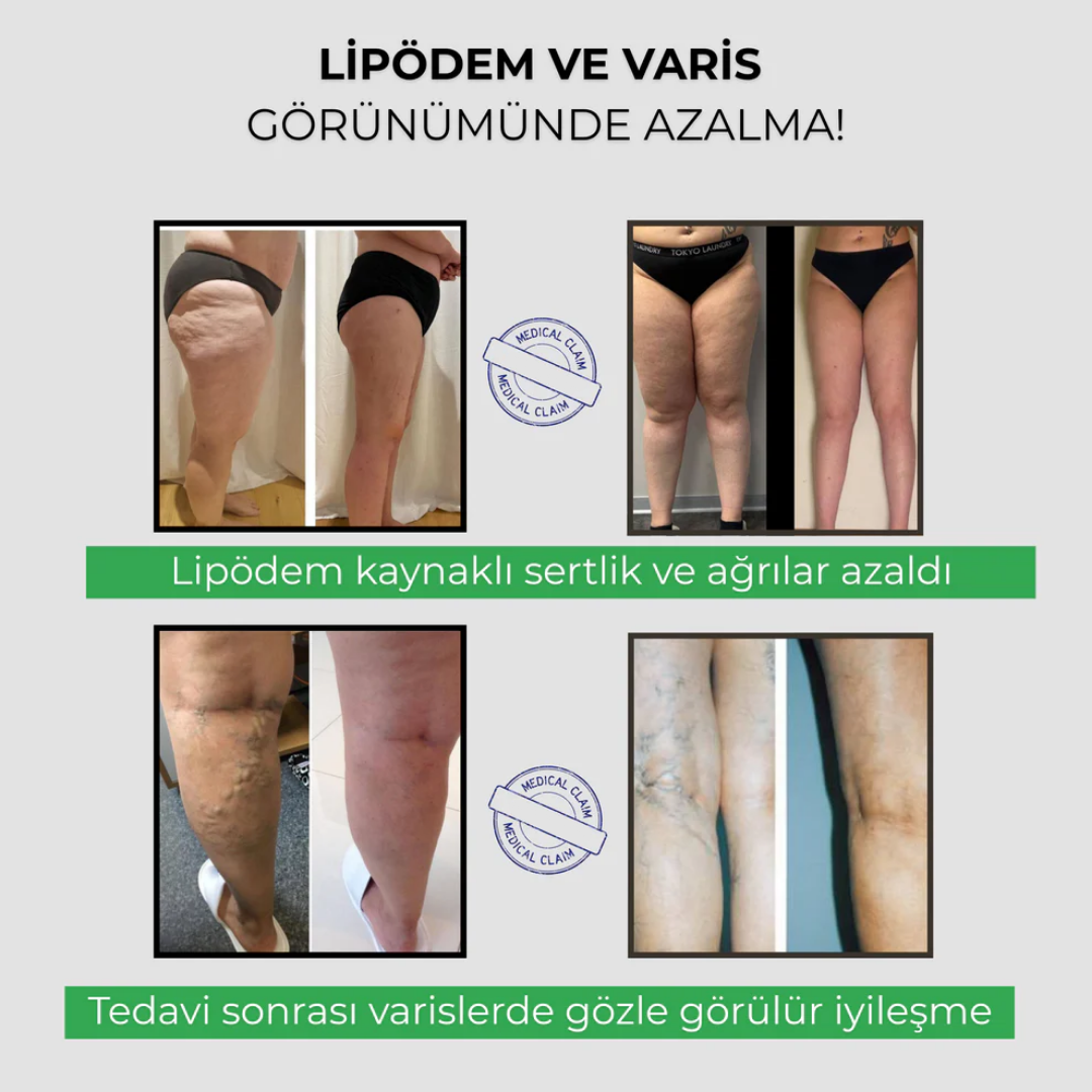 3'lü Etki Şekillendirici Lipödem, Selülit, Varis Silvesso™